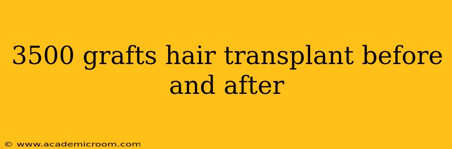 3500 grafts hair transplant before and after