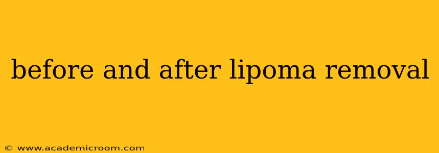 before and after lipoma removal