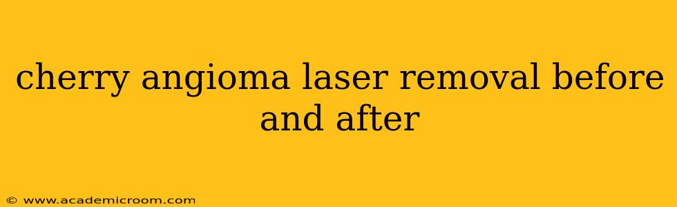 cherry angioma laser removal before and after