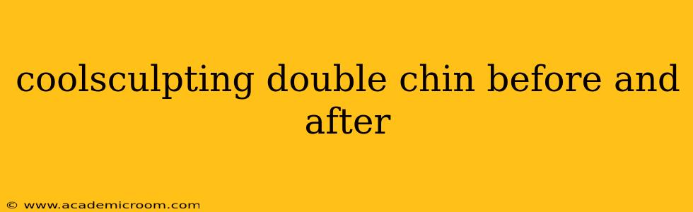 coolsculpting double chin before and after