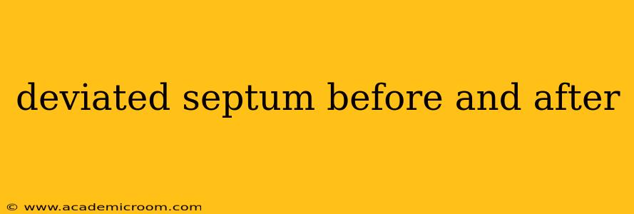 deviated septum before and after