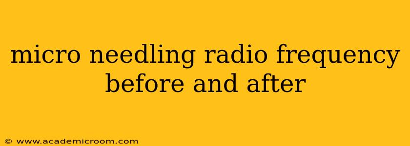 micro needling radio frequency before and after
