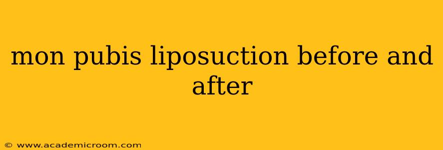 mon pubis liposuction before and after