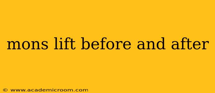 mons lift before and after
