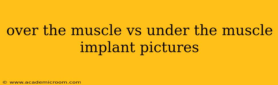 over the muscle vs under the muscle implant pictures