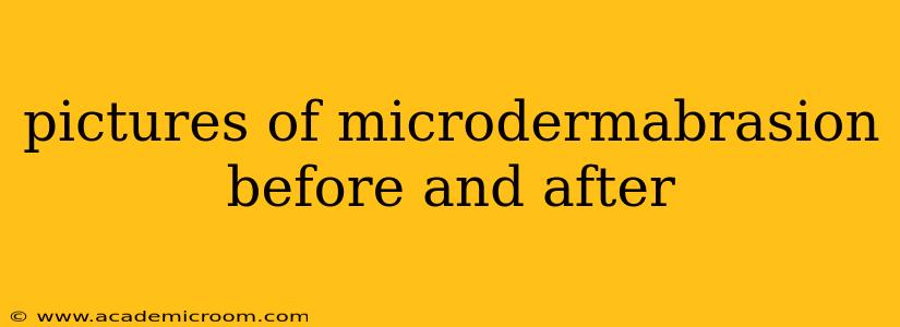 pictures of microdermabrasion before and after