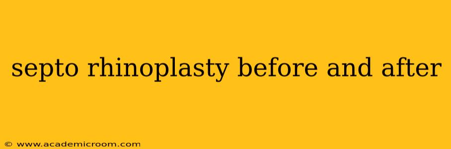 septo rhinoplasty before and after