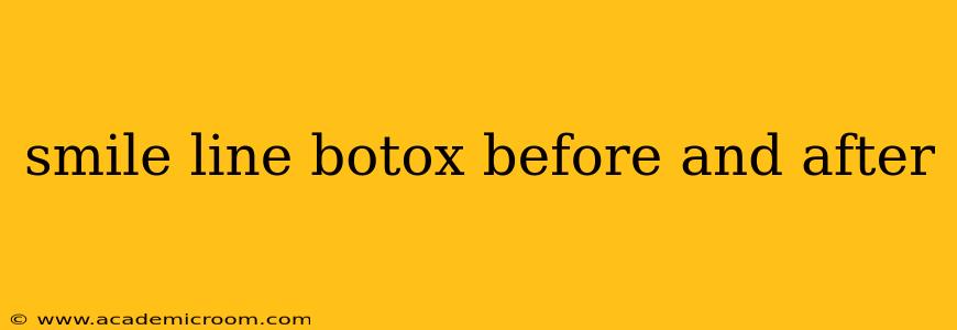 smile line botox before and after