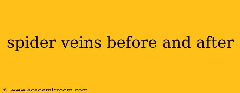 spider veins before and after