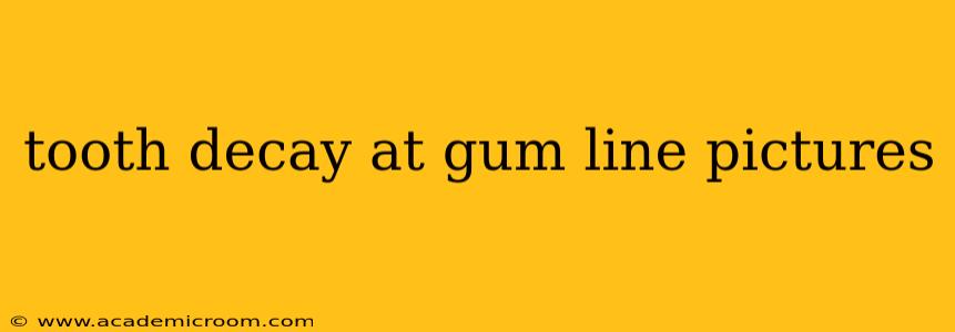 tooth decay at gum line pictures