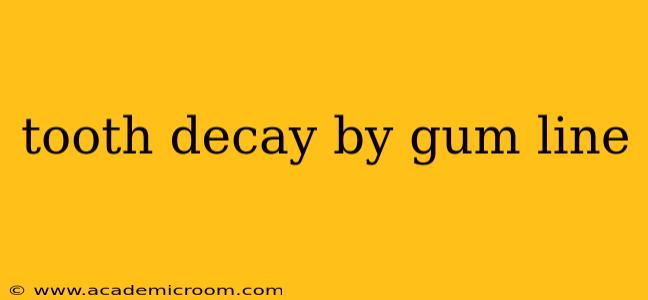 tooth decay by gum line
