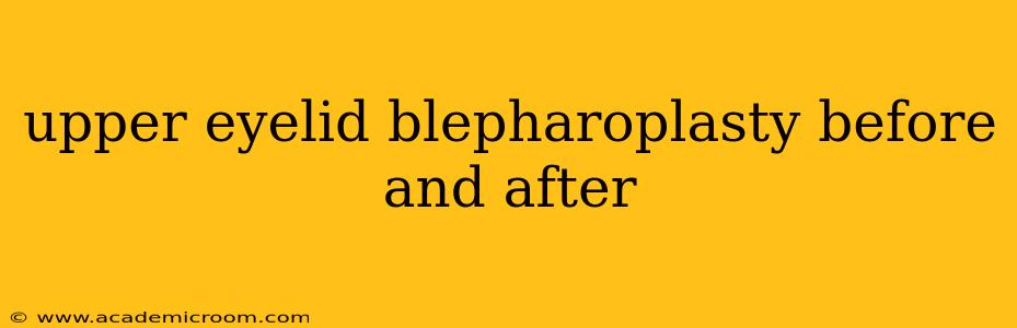 upper eyelid blepharoplasty before and after