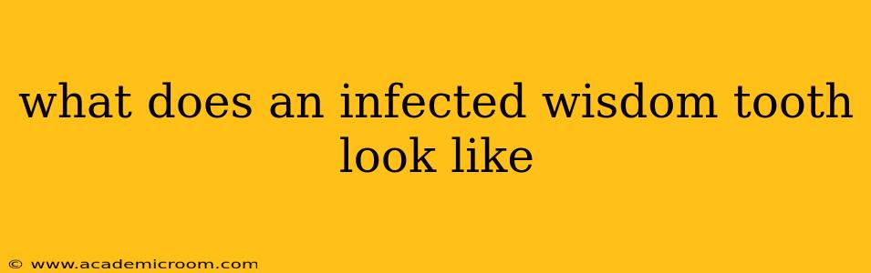 what does an infected wisdom tooth look like
