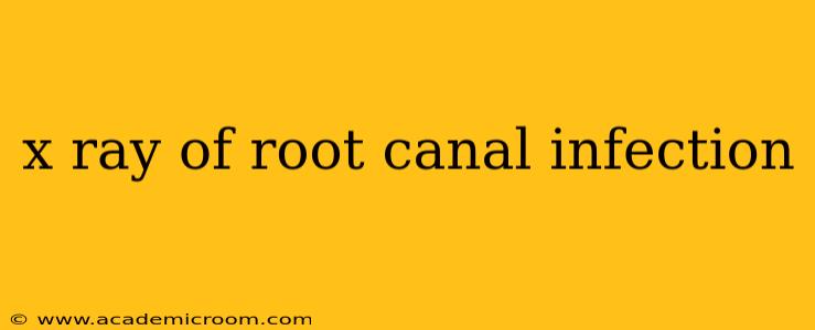 x ray of root canal infection